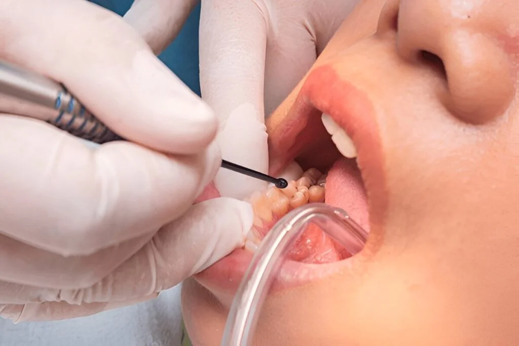 composite fillings near you